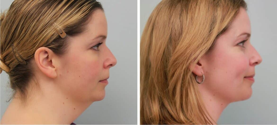 will-double-chin-go-away-with-weight-loss