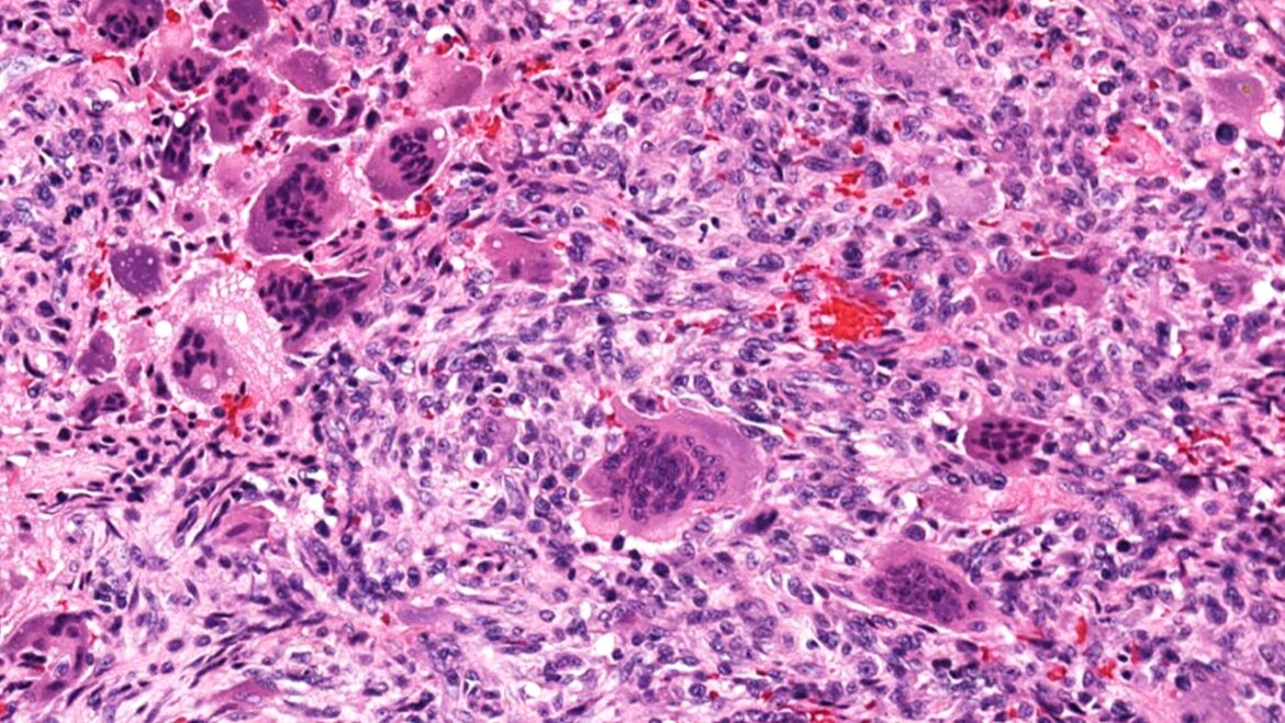 Why Does Giant Cell Arteritis Cause Weight Loss Why Does Giant Cell Arteritis Cause Weight Loss