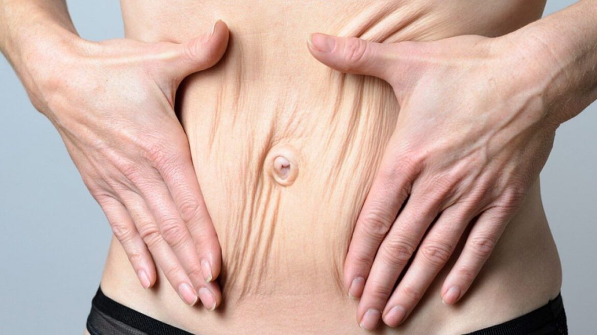 What Do Stretch Marks Look Like After Weight Loss